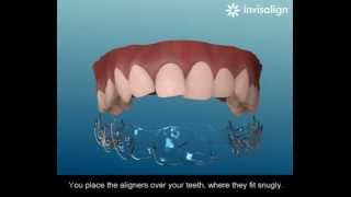 What is Invisalign [upl. by Sims946]