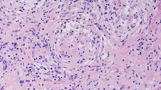 A Case of Granulomatous Orchitis  Pathology mini tutorial [upl. by Aserehs]