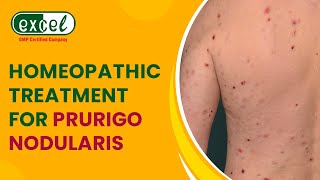 Prurigo Nodularis and Its Homeopathic Treatment  An Informative Video by Dr Anu Kant Goyal [upl. by Malkah]