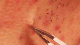 Plucking Neck Hair With Tweezers  Trichotillomania Trigger [upl. by Annoet]