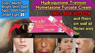 Hydroquinone Tretnoin Mometasone Furoate Cream  Scarlite  use and Side effects [upl. by Palocz]