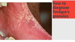 Fordyces Granules anatomy oral anatomy [upl. by Glynas612]