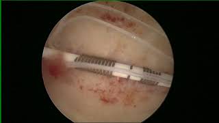 HYSTERSCOPIC Copper T removal [upl. by Enaj]