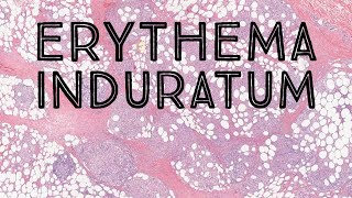 Erythema InduratumNodular Vasculitis panniculitis dermatology dermpath pathology dermatopathology [upl. by Dawkins]