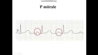 Pmitrale  Diagnosis of LAE [upl. by Juana]