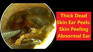 Thick Dead Skin Ear Peels  Skin Peeling Abnormal Ear 20231130 relaxing satisfying asmr [upl. by Anaeirb662]