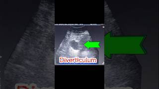 DIVERTICULA BLADDER  U bladder Stone  Cystitis  Residual Urine PMRV ultrasound [upl. by Jonette]