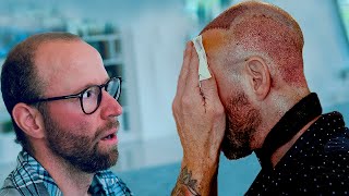 Are Hair Transplants PAINFUL Procedure and recovery  my experience [upl. by Nek]