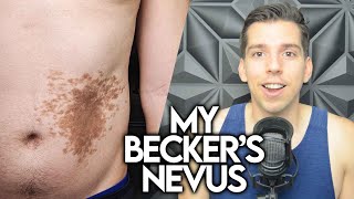 My Beckers Nevus Birthmark [upl. by Carhart]