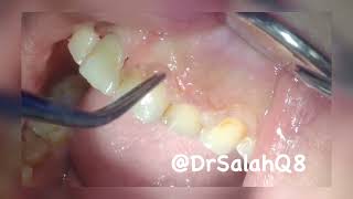 Waterlase Gingivectomy aesthetic crown lengthening for Gummy smile تجميل لثه بالليزر المائي [upl. by Layap]