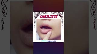 Cheilitis disease doctor nursing mbbs ytshorts education ssc song newsong [upl. by Nesbitt]