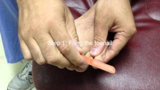 3 Simple tricks to help clear fungal toenails [upl. by Namad]