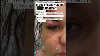 Types of acne vulgaris  treatment [upl. by Anauqat]