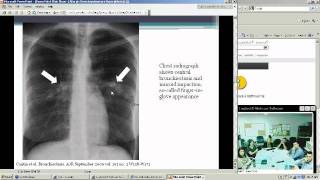 Allergic Bronchopulmonary Aspergillosis Heather Doss MD [upl. by Johna]