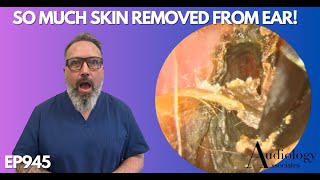 SO MUCH SKIN REMOVED FROM PATIENTS EAR CANAL  EP945 [upl. by Saundra]