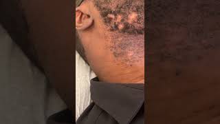 Keloid of Face  Treatment with cryotherapy [upl. by Moonier]