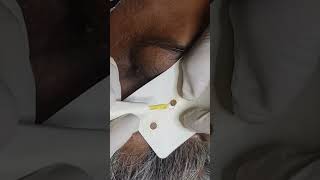 Sebaceous Hyperplasia Treatment with Lasers What You Need to Know [upl. by Anelagna]