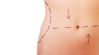 Tummy Tuck vs Liposuction  Plastic Surgery [upl. by Seira]