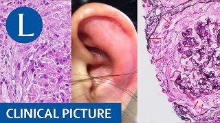 Episodic erythema of the ear is evidence of glomerulonephritis and polychondritis [upl. by Ashlin]