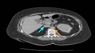 Clinical Case Renal Cell Carcinoma [upl. by Perpetua25]