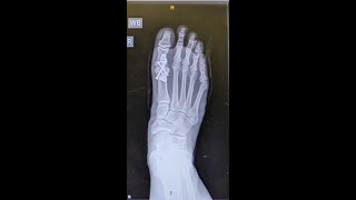 Successful Big Toe Fusion  Hallux Metatarsophalangeal Joint Fusion  Six Weeks Post Toe Fusion [upl. by Netnerb201]