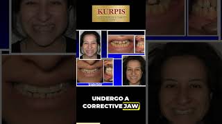 Underbite Correction Without Jaw Surgery [upl. by Merriman742]