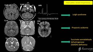 Globus Pallidus with Dr Asthik Biswas [upl. by Fredric]