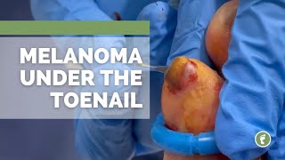 Melanoma UNDER the toenail [upl. by Leland880]