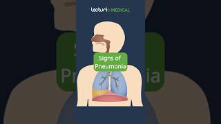 Recognizing the Signs of Pneumonia 🩺 MedicalEducation USMLE [upl. by Athalia627]