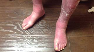 Walters Neuropathy and Edema Laser Therapy Relief Part 1 [upl. by Arinaj]