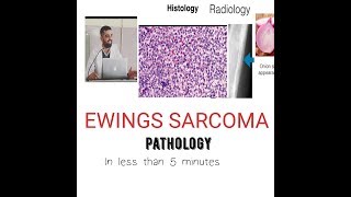 Bone tumor Pathology Ewing Sarcoma [upl. by Martens]