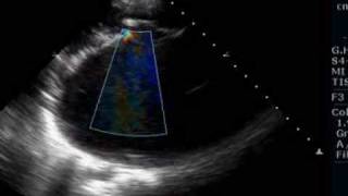 Giant left atrium due to rheumatic mitral stenosis and regurgitation [upl. by Alaikim]