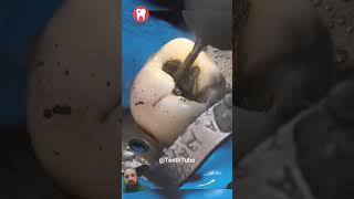 Amalgam Filling Removal dentist dentalfilling satisfying smiledentist oddlysatisfying [upl. by Hpsoj]