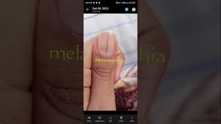 melanonychia causes follow support support followme dermatologyviral malignant melanoma [upl. by Htieh633]