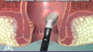 Infrared Coagulation Therapy for Hemorrhoids  3D Medical Animation [upl. by Stevy]