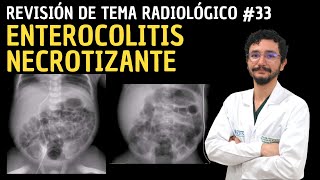 Revisión de Tema Radiológico 33 Enterocolitis necrotizante [upl. by Asirram]