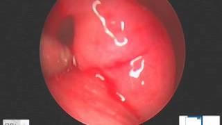 dilatation trompe dEustache  tuboplastie  balloon dilation of auditory tube [upl. by Avehs]