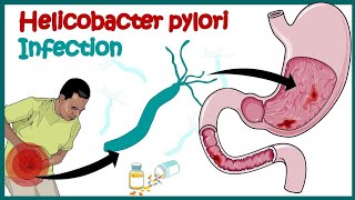 Helicobacter Pylori Infection Gastric Ulcer Causes Signs and Symptoms [upl. by Llevrac249]