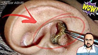 Thats Biggest Ear Wax Removal  Ear wax Removal amp Cleaning  Part 3 [upl. by Irej]