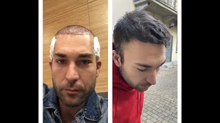 TRAPIANTO DI CAPELLI  MINOXIDIL O FINASTERIDE ECCO IL MIO RISULTATO DOPO 3 MESI [upl. by Amador]