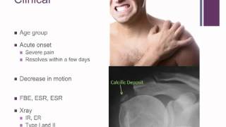 Dr Marc Friso  Calcific Tendinitis of the Shoulder [upl. by Anasxor808]