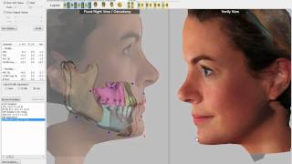 3D Visual Treatment Objective VTO Software Demo [upl. by Shornick]