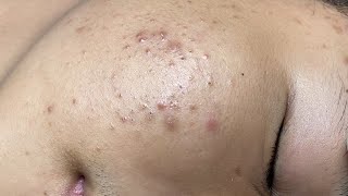 ACNE TREATMENT VU QUYNH MI  Perennial Blackheads On Boy Face 2024FULL [upl. by Dygall117]