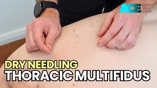 Dry Needling Thoracic Multifidus [upl. by Dilks592]