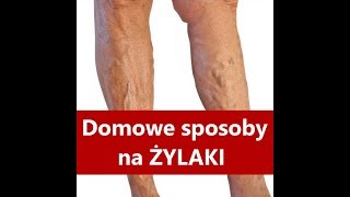 Żylaki  Domowe sposoby na ŻYLAKI [upl. by Toscano848]