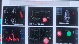 Place du strain dans la cardiomyopathie ischémique [upl. by Adelaja]