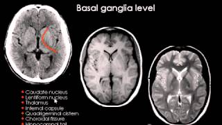 Normal brain anatomy CT and MRI YouTube [upl. by Hillary13]