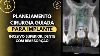 PLANEJAMENTO CIRURGIA GUIADA PARA IMPLANTE INCISIVO SUPERIOR DENTE COM REABSORÇÃO [upl. by Annwahs]