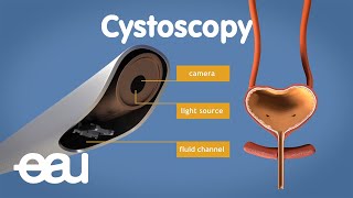 Cystoscopy overactive bladder [upl. by Ennahtur]