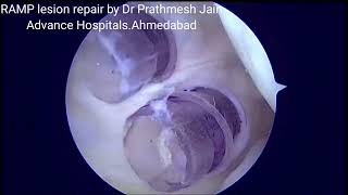 RAMP lesion repair using Posteromedial Portals [upl. by Nahtnhoj]